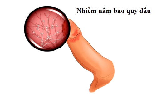 Hình ảnh nấm bao quy đầu